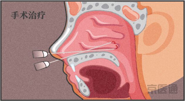 小孩刚开始患过敏性鼻炎能根治吗,过敏性螨虫鼻炎的根治方法是什么