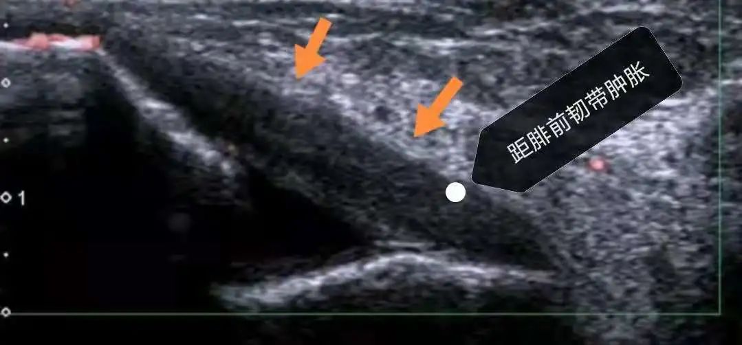 手麻肌电图检查过程视频,手麻脚麻肌电图正常