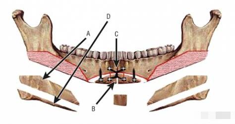 那些一刀切削骨的明星还好吗？后遗症一大堆，小方脸成最大赢家