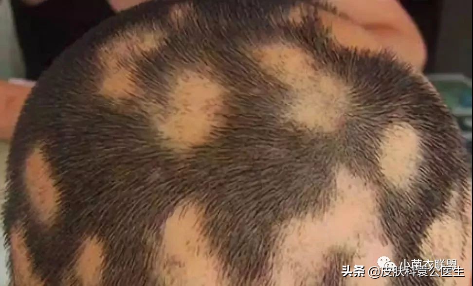 脱发严重但是头发还是很浓密,脱发头发油腻怎么办