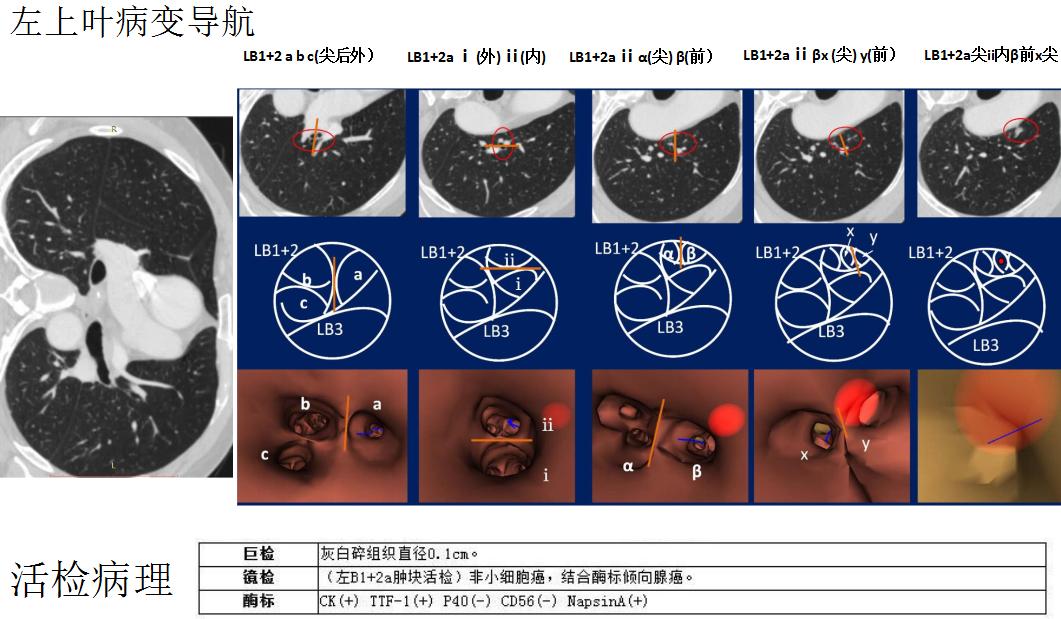 支气管镜高频电刀治疗中央型肺癌,支气管镜在早期肺癌诊断的意义