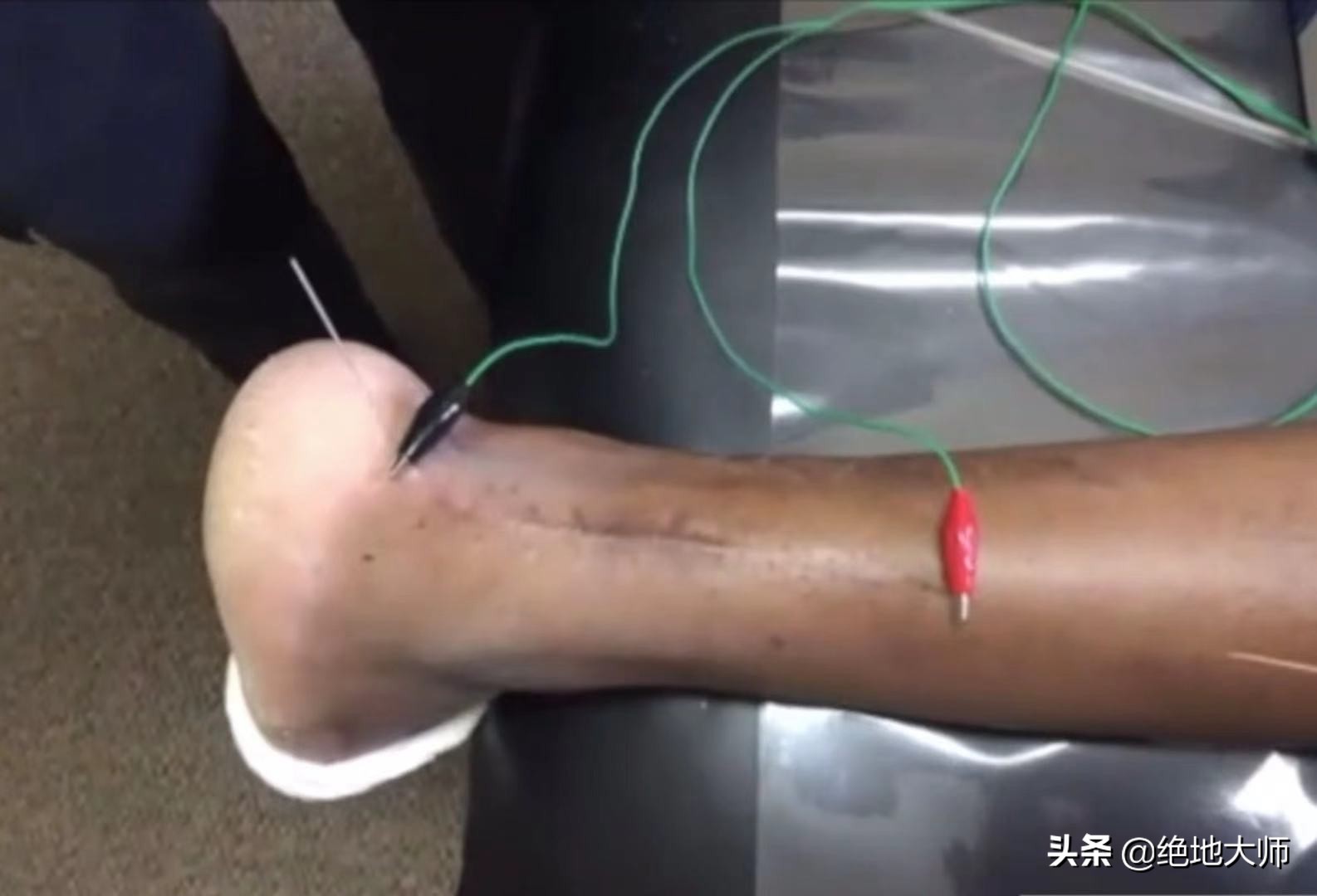 脊神经脉冲射频术后如何康复训练,神经射频术后疼痛难忍