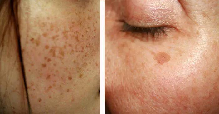 祛脸上斑点色斑的小妙招,一个动作教你如何淡化色斑