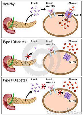 糖尿病用的胰岛素泵使用方法,糖尿病患者用泵调整基础胰岛素