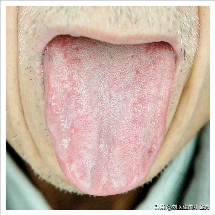 中医舌诊图解100例,中医舌诊图与舌诊口诀