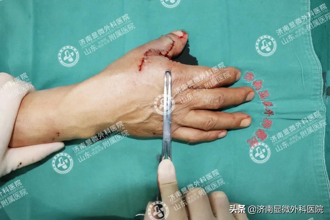 手指少了一块肉怎么处理,手指少了一截