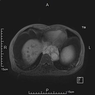 肝癌门静脉癌栓能做介入手术吗,肝癌门静脉癌栓中医治疗