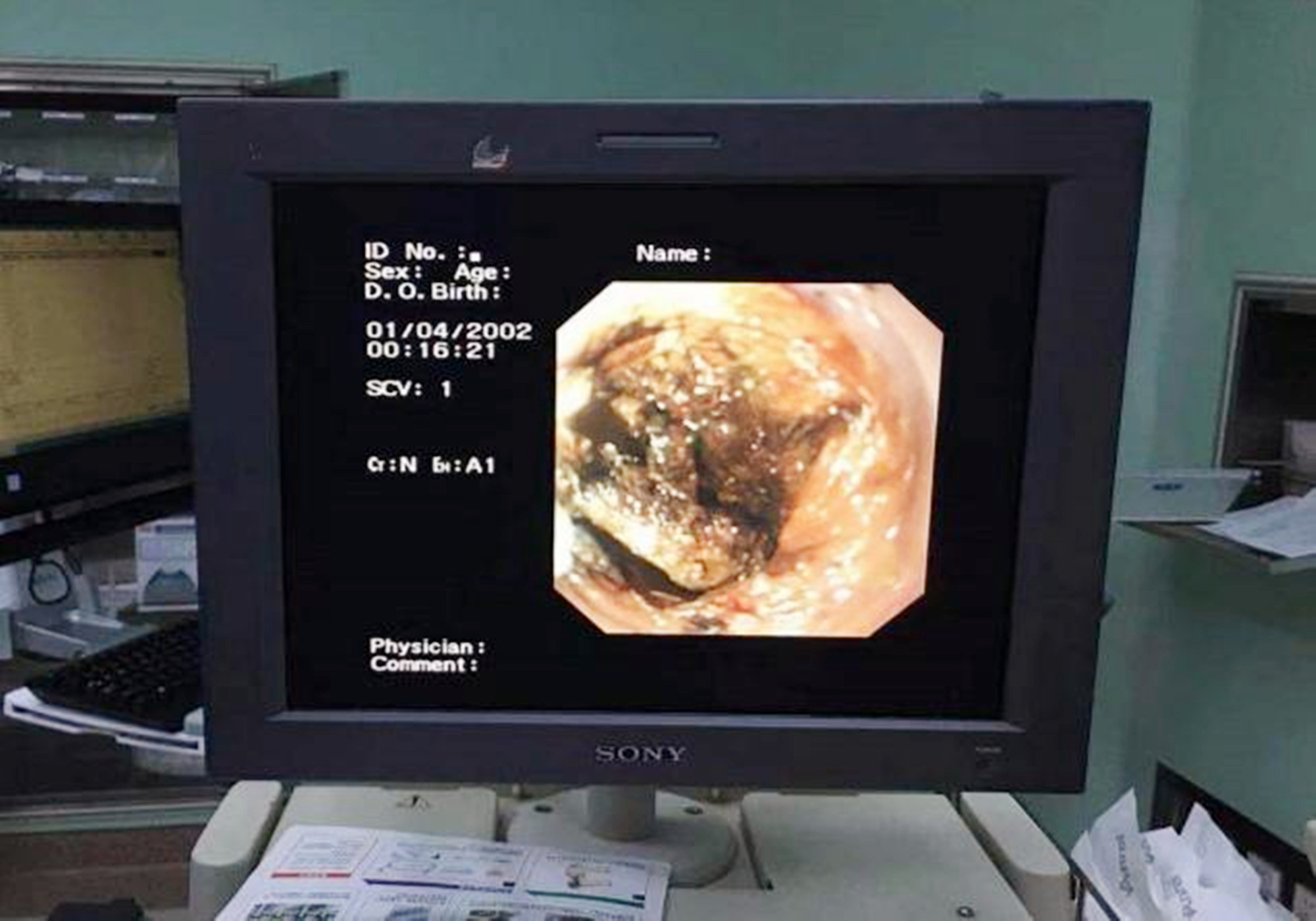 宝宝误吞纽扣,孩子误吞异物妈妈急救