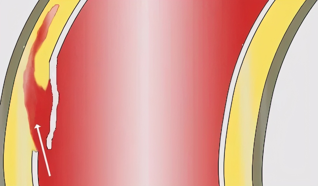 一天接诊5例主动脉夹层！冬季高发，越来越年轻化！主动脉夹层的高危因素都是你的最爱