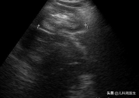 婴儿哭闹不一定是饿了,宝宝肠绞痛每天半夜准时哭闹