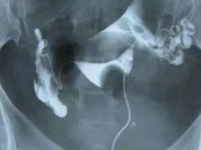 如果输卵管堵塞可以促排吗,输卵管不通畅可以促排吗