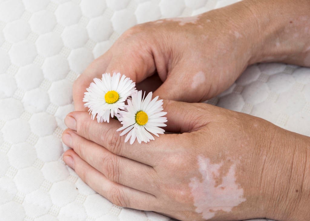 怎样才对白癜风有帮助,白癜风的误解