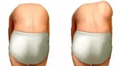 18岁少女脊柱严重侧弯元凶,16岁女童脊柱侧弯