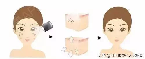 激光护理知识,激光治疗护理