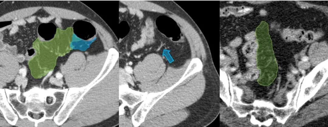 这样的解剖结构容易忘？重新认识肠系膜