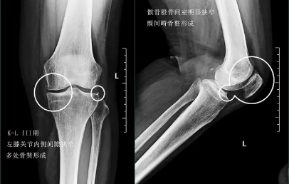 关节炎辟谣,膝关节滑膜炎辟谣