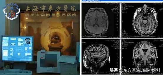 精神病人大量服用抗精神病药物被副作用摧残该怎么办?