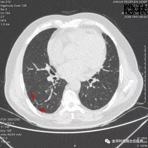 警惕-会是简单的肺大泡吗？