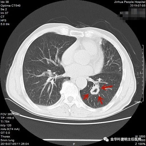 叶建明谈实性结节,叶建明肺实性良性结节会变癌症吗