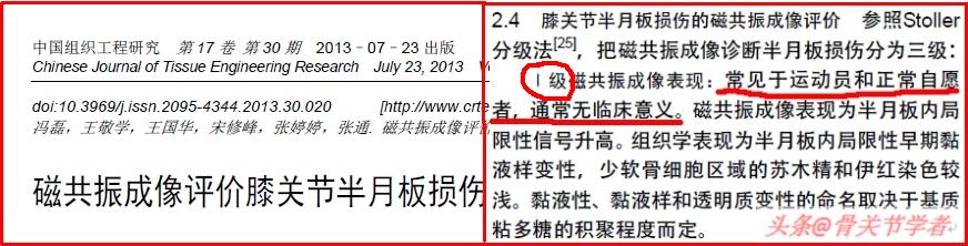 磁共振怎么看半月板损伤程度,磁共振半月板损伤1级是什么