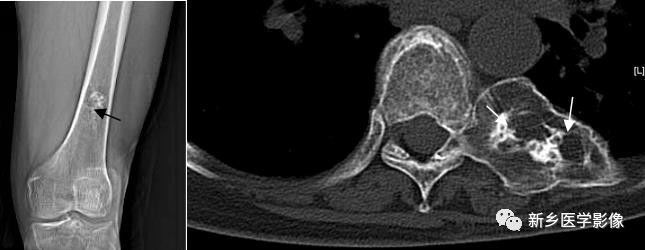 骨骼坏死最佳治疗方法,骨骼疾病治疗