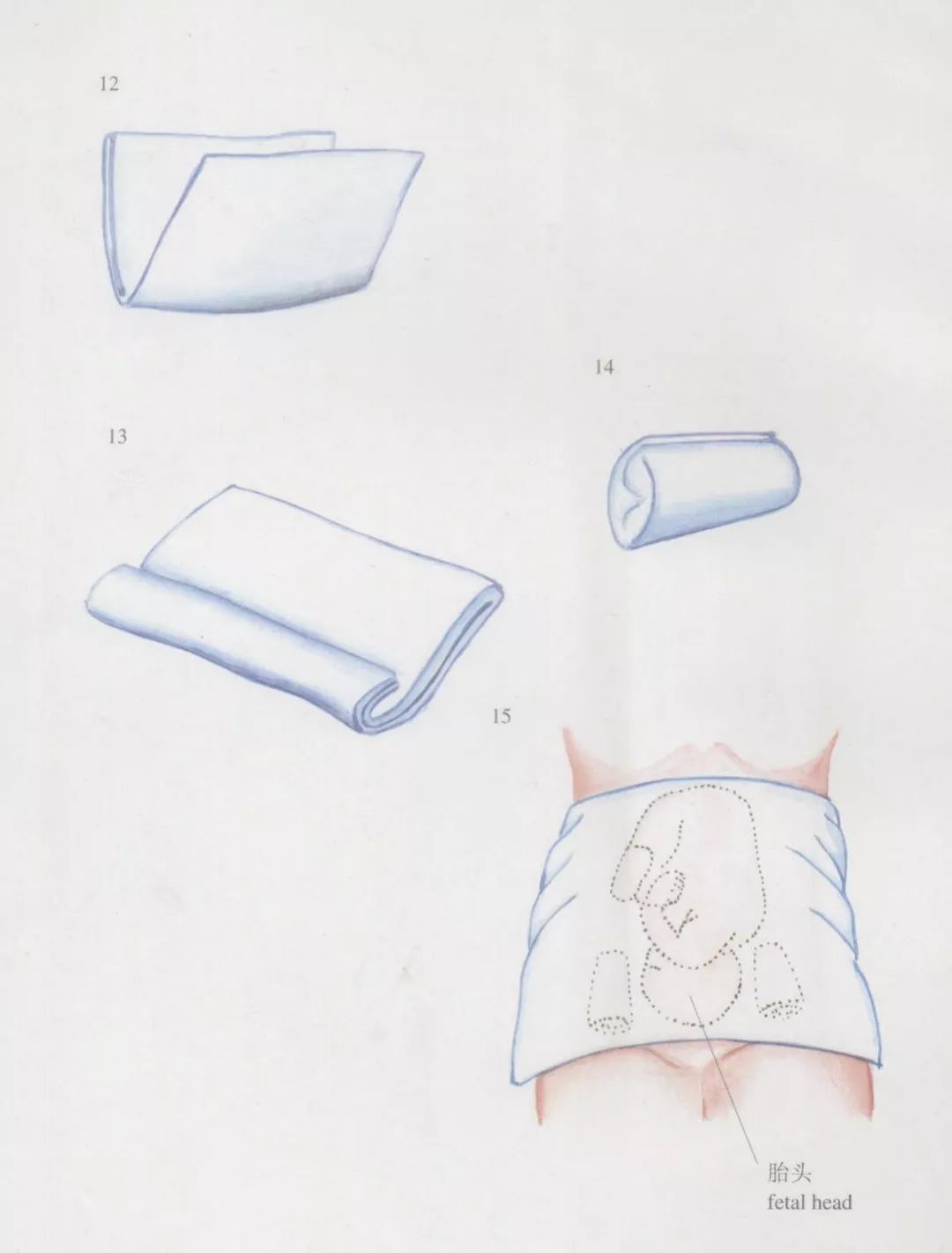 臀位外倒转术一般多少周做,孕妇臀位外倒转术视频