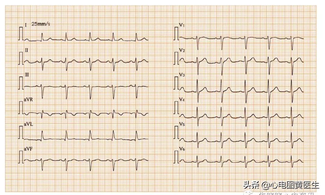 左前分支传导阻滞前胸痛怎么办,左前分支传导阻滞趋势
