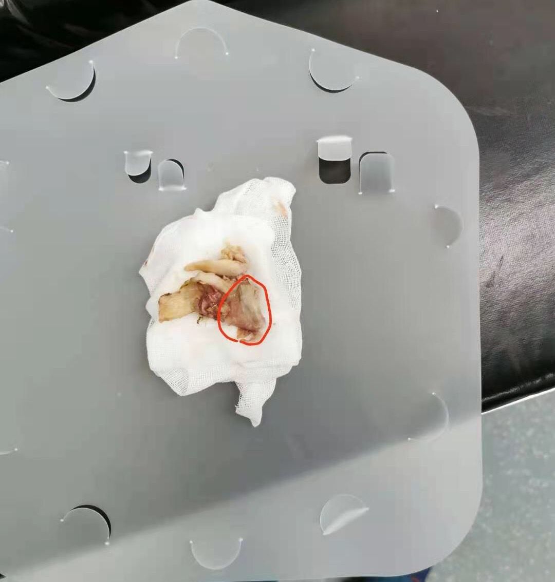 鹅足骨刺,吃骨头误吞导致食道穿孔