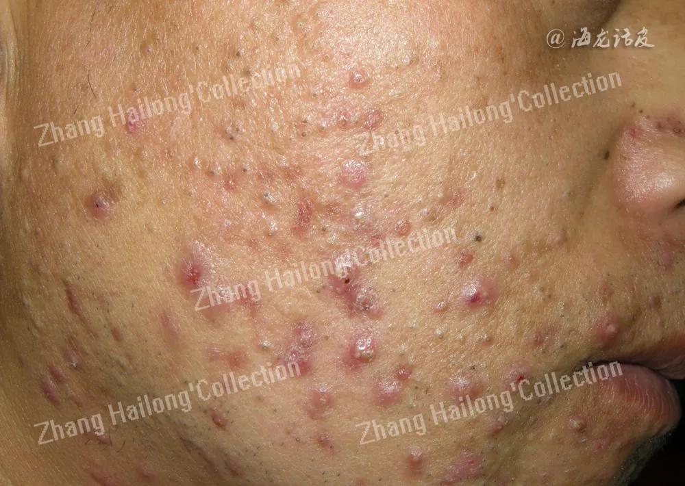 阿达帕林能治痤疮吗,托法替布在皮肤科的应用