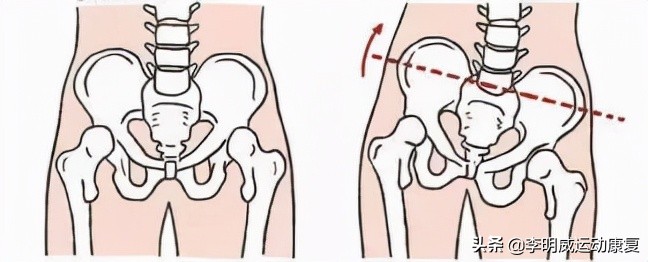 骨盆前倾骨盆不正怎么恢复,骨盆不正会造成什么后果