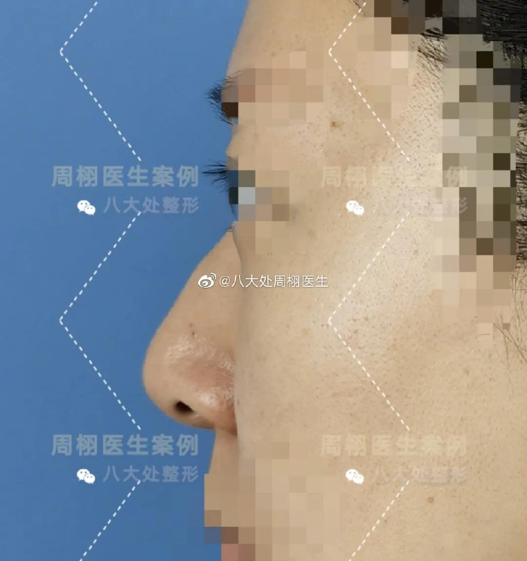 鼻整形手术,鼻整形术