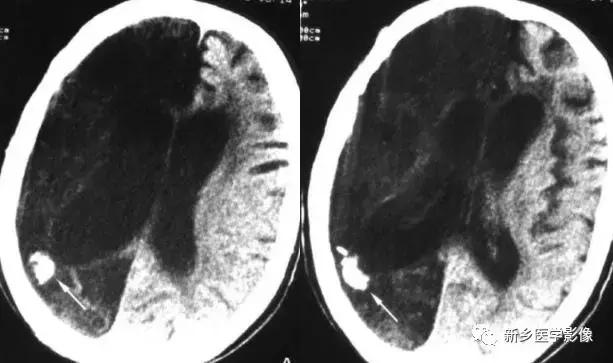 颅内有钙化怎么治疗,34岁脑部有钙化正常吗