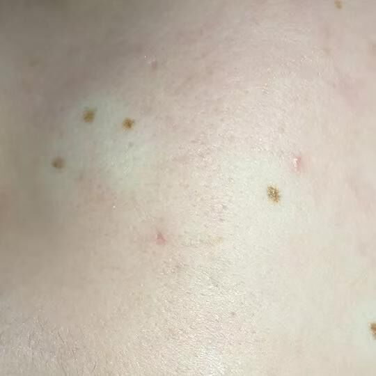 激光祛痣怎么好得快不留疤,激光祛痣亲身经历和感受