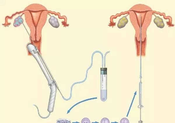 女明星接连去冻卵,好多明星冻卵以后怎么生孩子