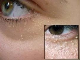 10岁为什么在眼睛旁边会长脂肪粒,三十几岁眼睛周围脂肪粒多怎么办