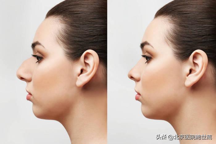 青春期驼峰鼻怎么自然矫正,驼峰鼻怎么自己矫正中学生