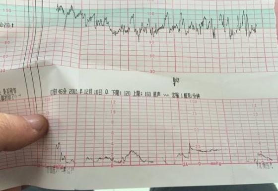 孕33周胎心监测应该在哪个位置,医生如何看胎心监护图
