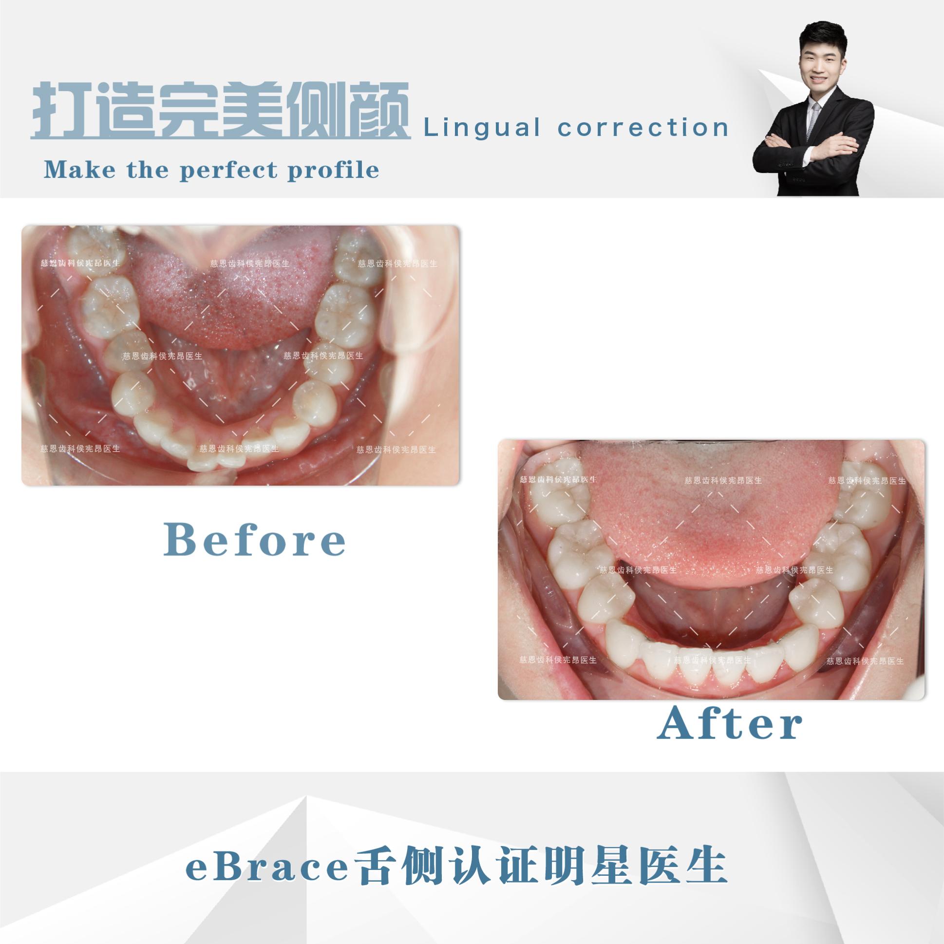 牙突怎么矫正,怎么矫正嘴突