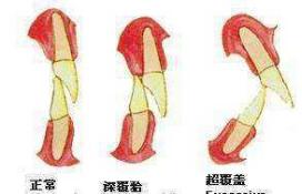 一笑就露牙龈怎么办,一笑牙龈露太多怎么治疗