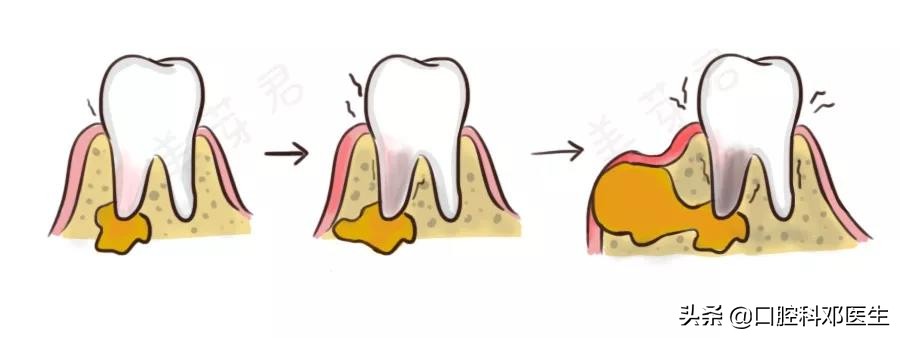 疫情后牙齿怎么修复好一点,新冠肺炎有牙齿方面的症状吗