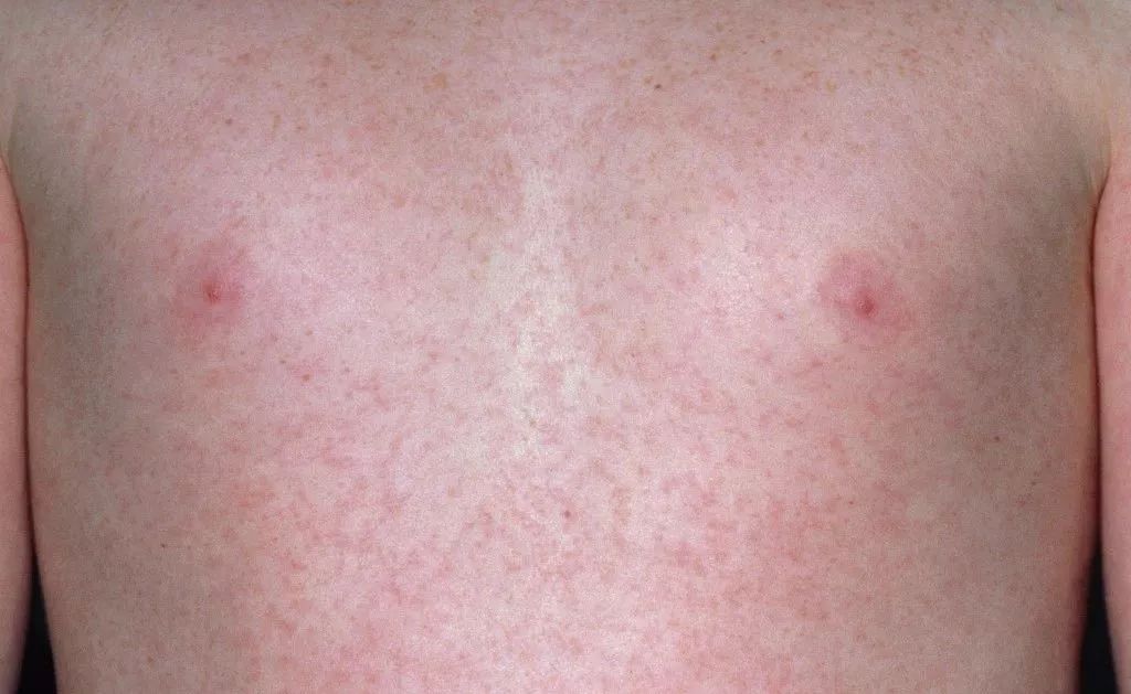 近期儿童流行疾病,儿童常见的疾病预防知识