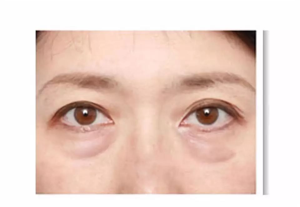 下眼袋浮肿与大眼袋区别,40岁消除眼皮浮肿和眼袋