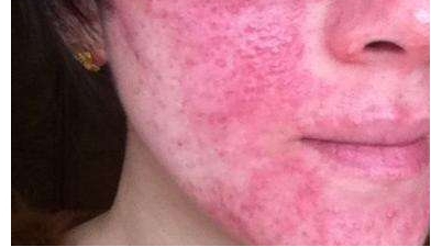 崔雪莉抑郁自杀,英国伯奢BOXURY发现痘痘竟然也能引发抑郁