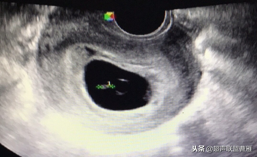 3毫米卵黄囊未见胎芽正常么,40多天的卵黄囊