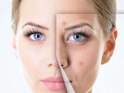 亲测有效祛痘印小妙招,真正可以消除痘印的方法