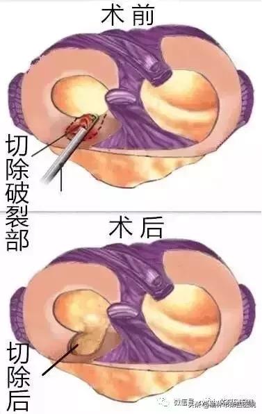 内侧半月板后角损伤怎么治疗,prp治疗半月板损伤有用吗