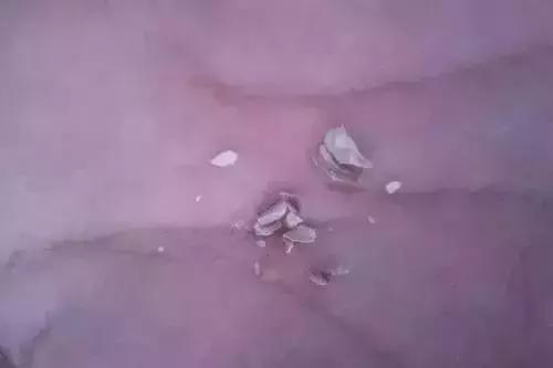 牙结石自己用手抠掉了,你用手抠过牙结石吗