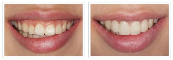 一口黄牙怎么办？10年牙科医生教你怎么拥有一口亮白美牙