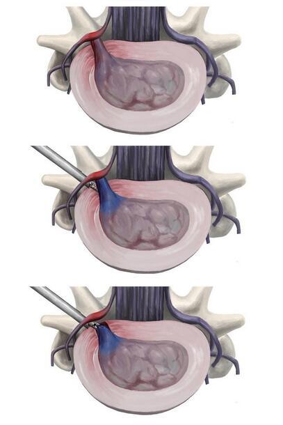 腰间盘突出保守治疗和微创哪个好,腰椎突出微创和保守治疗哪个好
