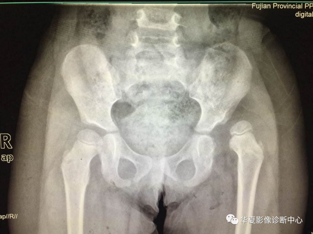 先天性髋关节脱位截骨术全过程,先天性髋关节脱位可以考驾驶证吗